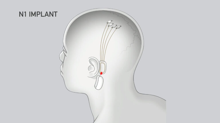 Neuralink получила разрешение на испытания на людях